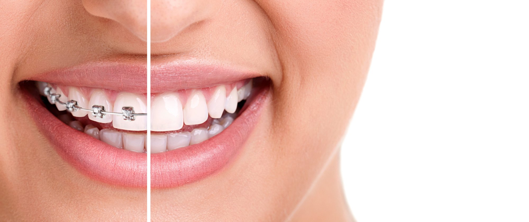 3 Facts to Know About Getting Partial Braces - Trending blog Post