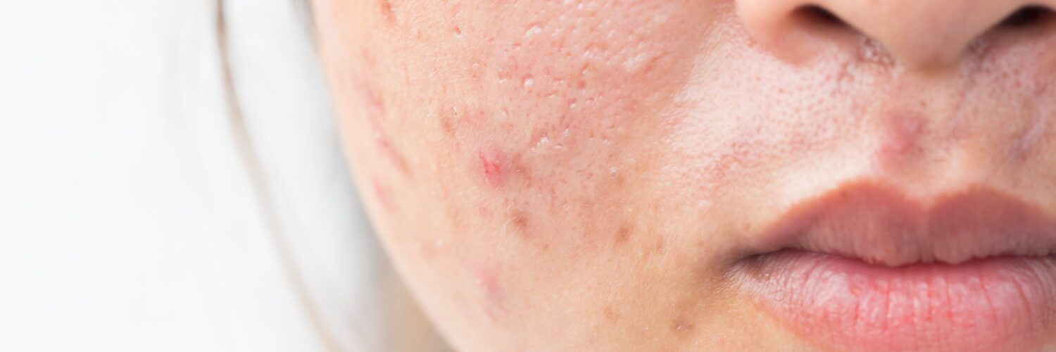 Debunking Common Myths About Acne Marks vs Acne Scars: Separating Fact ...