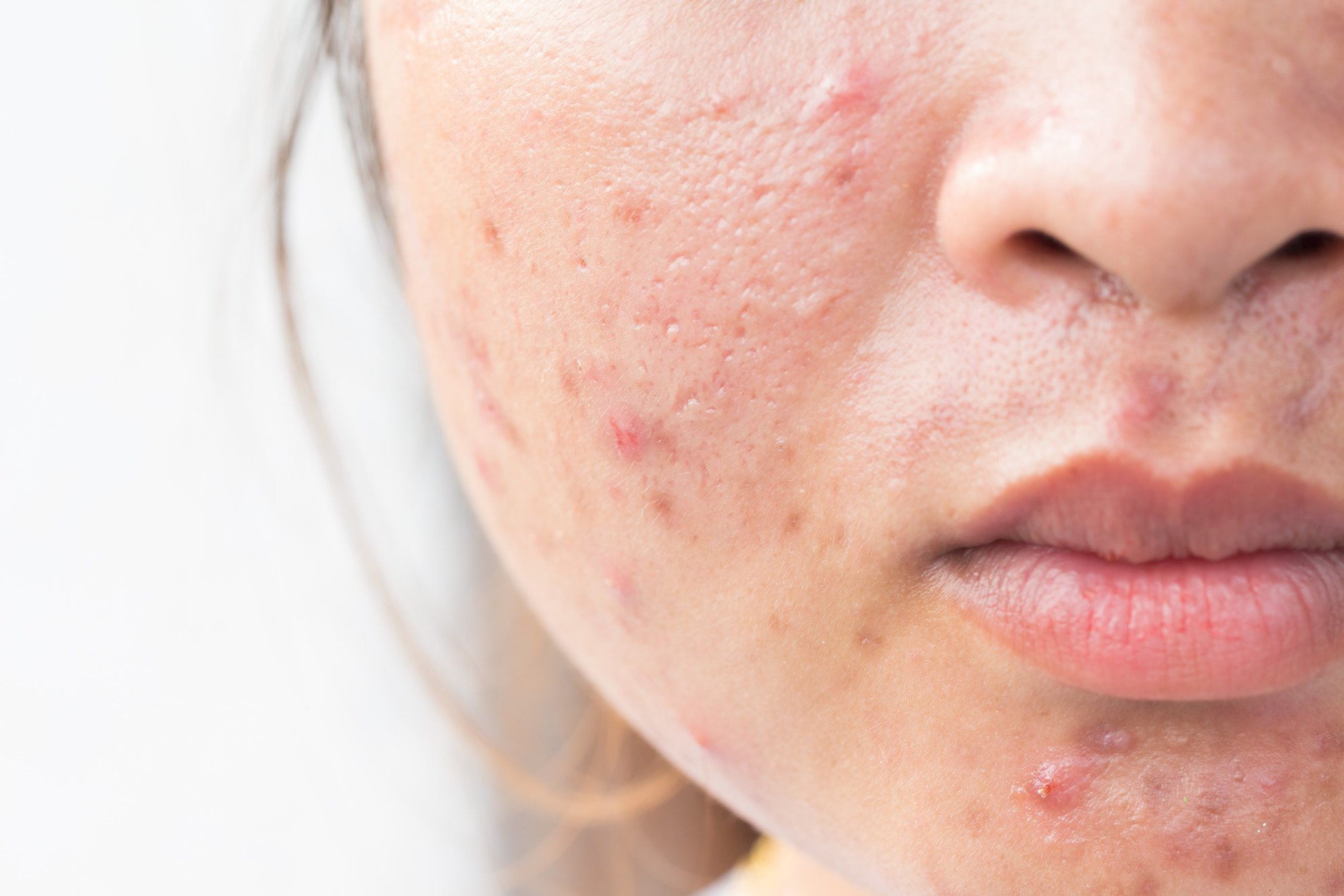 Debunking Common Myths About Acne Marks vs Acne Scars: Separating Fact